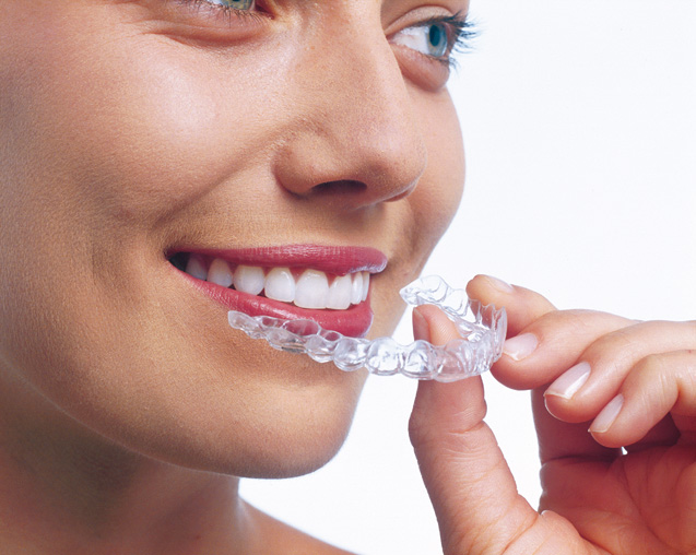 Rechte tanden door onzichtbare Invisalign beugel